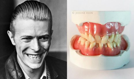 HeinBowieTeeth.jpg